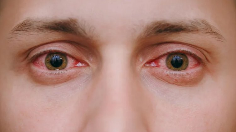 Eye Flu: Causes, Symptoms, Treatment, Prevention